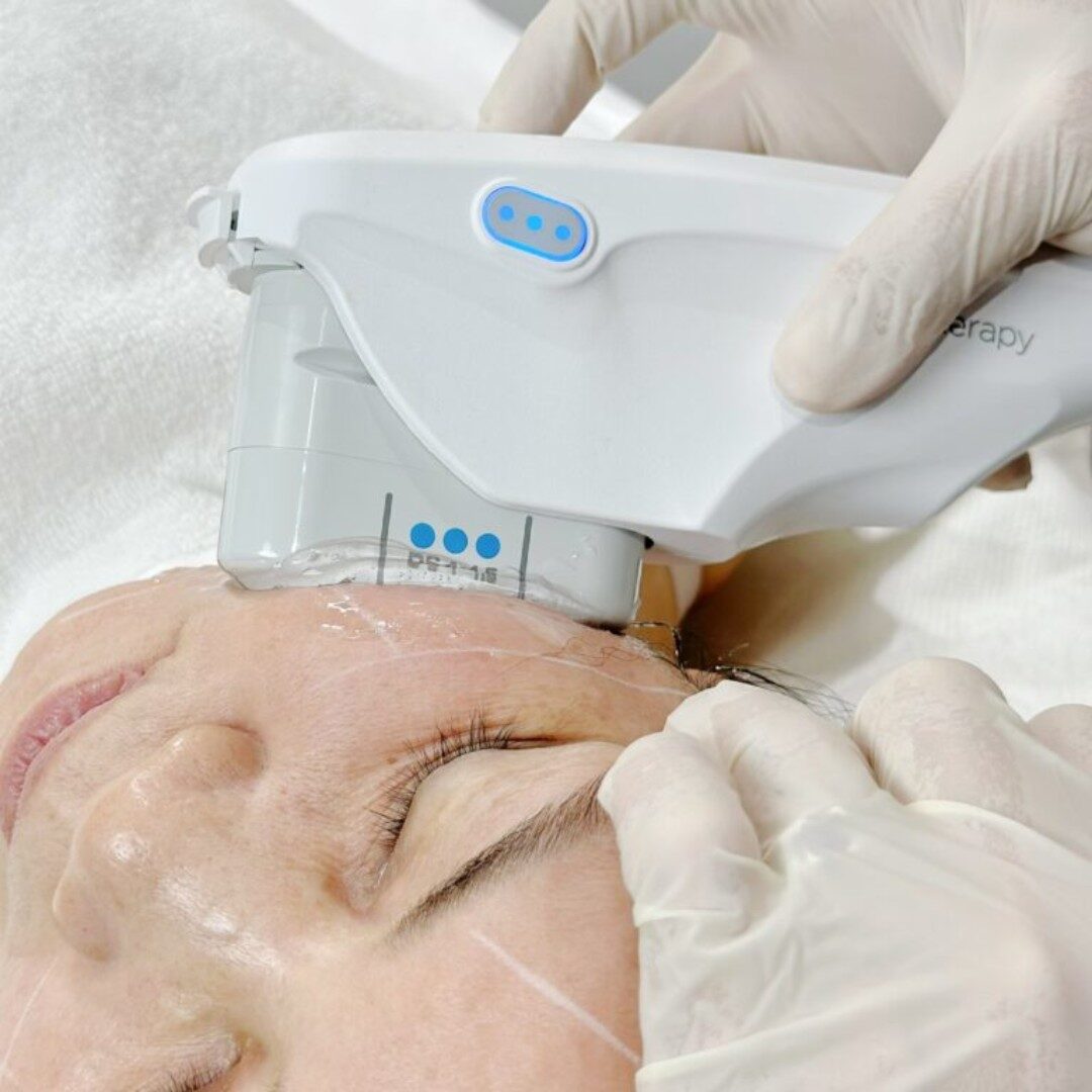 Ultherapy Prime - LDP Giảm mỡ mặt