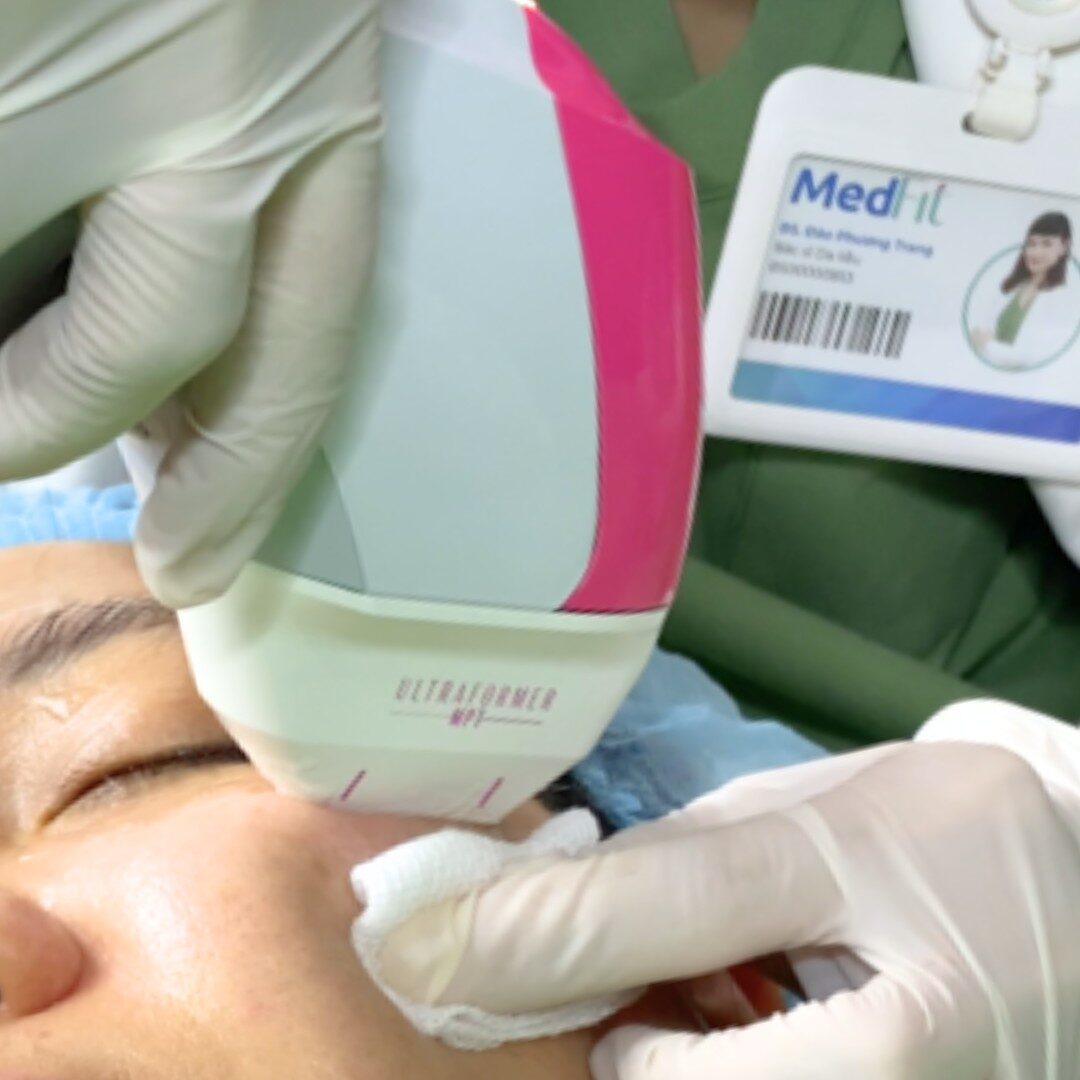 Ultraformer MPT - Trẻ hóa vùng mắt