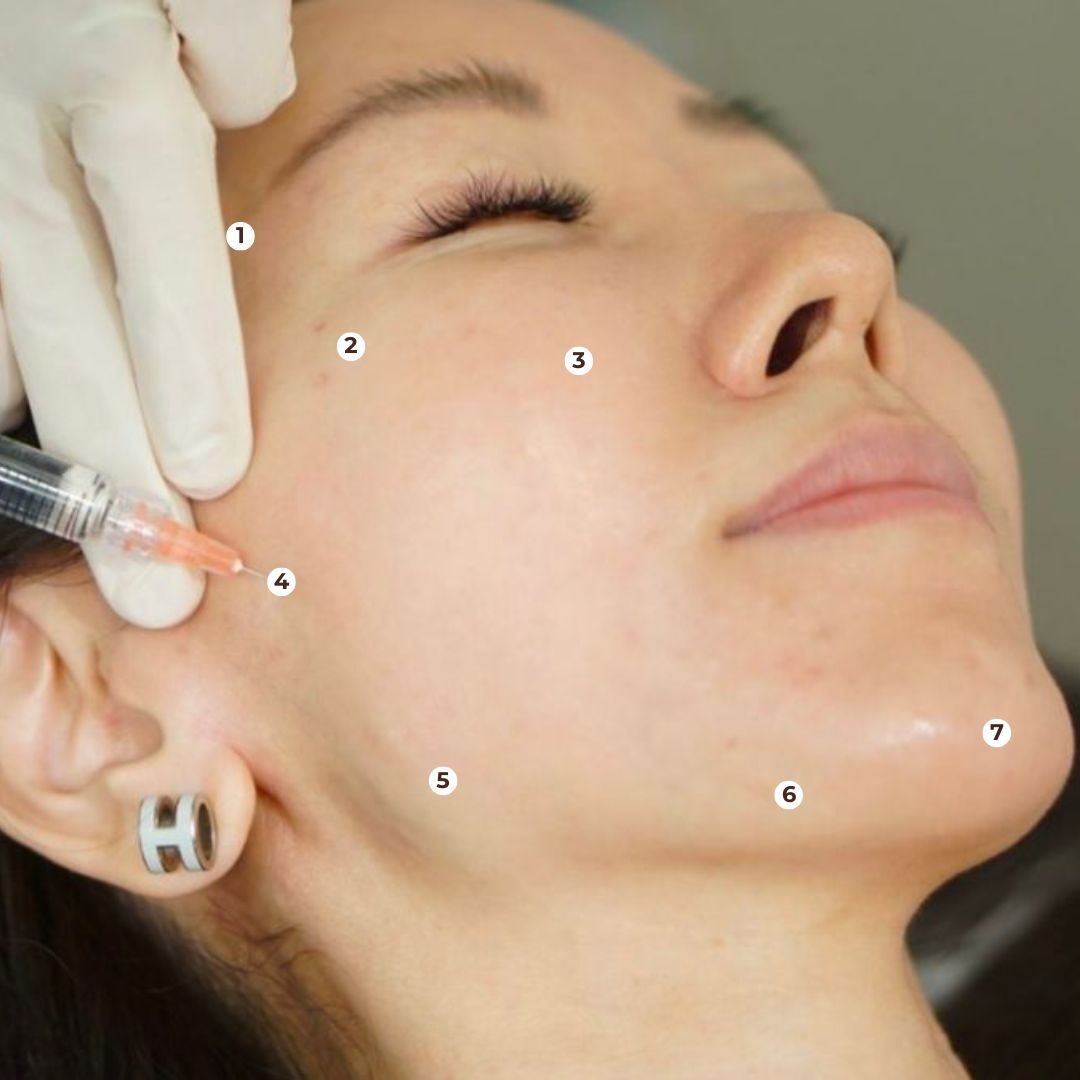 Vị trí tiêm Jalupro