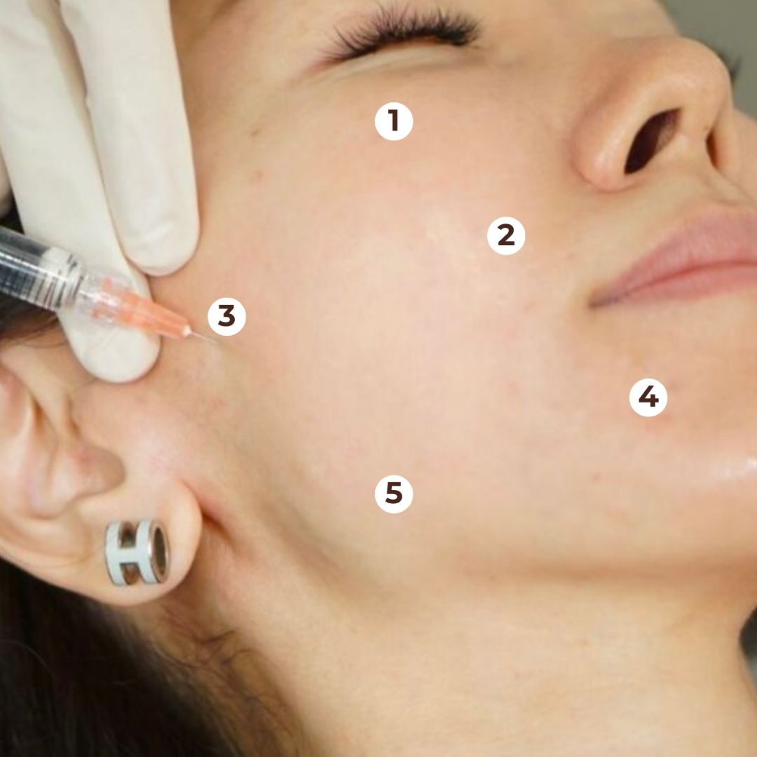 Vị trí tiêm Profhilo