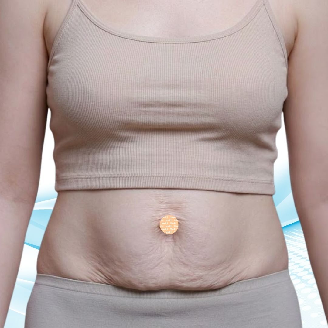 tách cơ bụng sau sinh